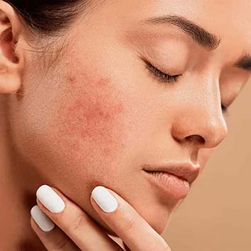 Acne and Pimples