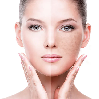 Pigmentation