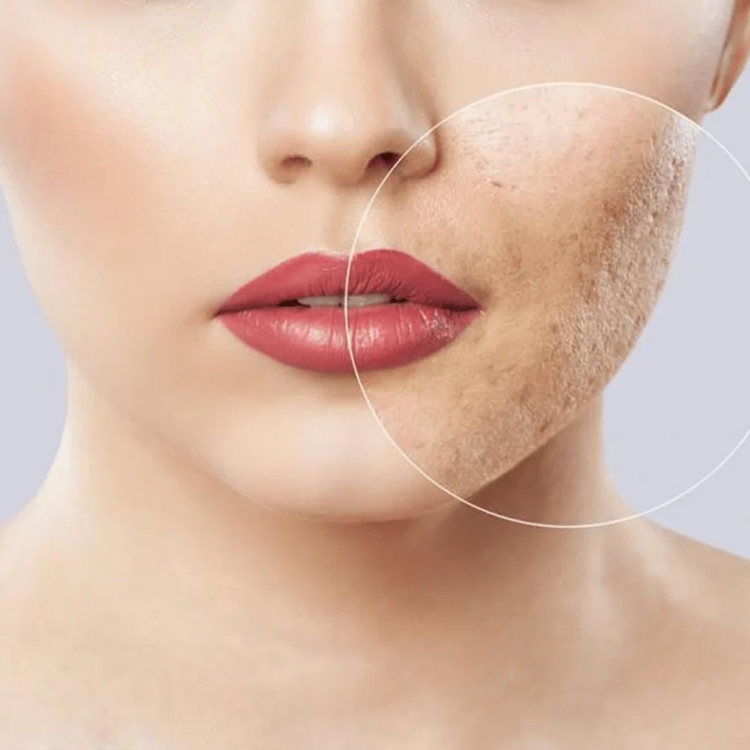 Acne Scars