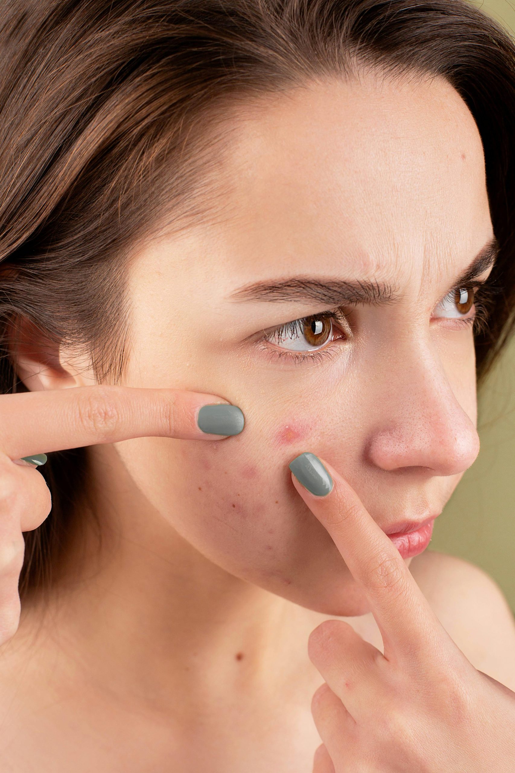 Effective acne treatment